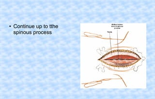 ●

Continue up to tthe
spinous process

 