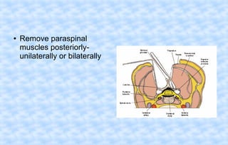 ●

Remove paraspinal
muscles posteriorlyunilaterally or bilaterally

 