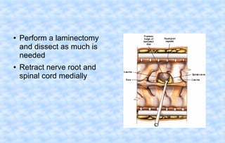 ●

●

Perform a laminectomy
and dissect as much is
needed
Retract nerve root and
spinal cord medially

 