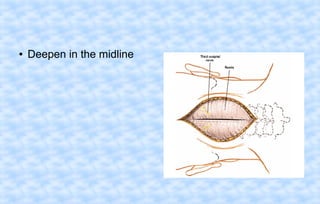 ●

Deepen in the midline

 