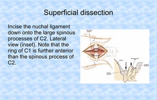 Superficial dissection
Incise the nuchal ligament
down onto the large spinous
processes of C2. Lateral
view (inset). Note that the
ring of C1 is further anterior
than the spinous process of
C2.

 