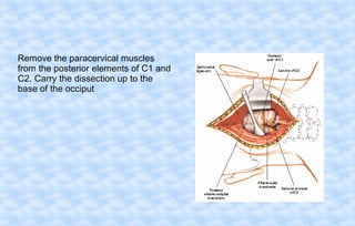 Remove the paracervical muscles
from the posterior elements of C1 and
C2. Carry the dissection up to the
base of the occiput

 
