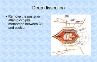Deep dissection
●

Remove the posterior
atlanto occipital
membrane between C1
and occiput

 