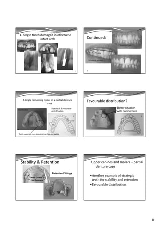 8
1. Single tooth damaged in otherwise 
intact arch
1
Continued:
Temporary crown
Orthodontic extrusion
Final Crown
1
2.Single remaining molar in a partial denture 
case
Stability & Favourable
Arch Position
Distribution
Tooth supported more desirable than free-end saddle
3
Favourable distribution?
Better situation
with canine here
3
Stability & Retention
Milled Cro ns
Retentive Fittings
Milled Crowns
Ball Retainers
Upper canines and molars – partial 
denture case
Another example of strategic p g
teeth for stability and retention
Favourable distribution
 