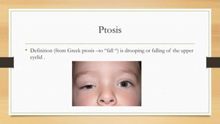 Ptosis
• Definition (from Greek ptosis –to “fall “) is drooping or falling of the upper
eyelid .
 