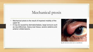Mechanical ptosis
• Mechanical ptosis is the result of impaired mobility of the
upper lid.
• It may be caused by dermatochalasis, large tumours such
as neurofibromas ,heavy scar tissue, severe oedema and
anterior orbital lesions.
 
