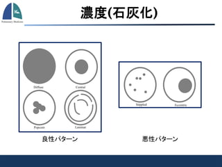 悪性パターン良性パターン
CentralDiffuse
Popcorn Laminar
Stippled Eccentric
濃度(石灰化)
 