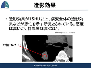 Kameda Medical Center
造影効果
• 造影効果が15HU以上、病変全体の造影効
果などが悪性を示す所見とされている。感度
は高いが、特異度は高くない。
Radiology 2000;214:73-80
CT値：34.7 HU
 