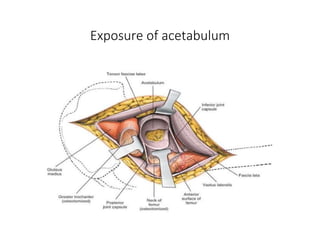Surgical Approach to Hip and Acetabulum | PPTX