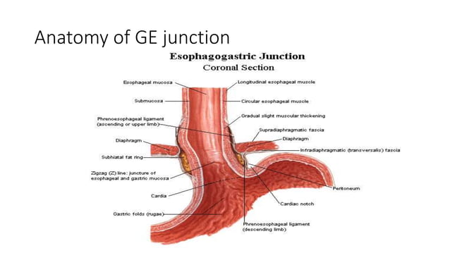 Gerd Name Approach, indications and surgical management of gerd 2 | PPTX