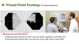Visual Field Computerixe Approaching Hyperprolactinemia an treatment | PPTX