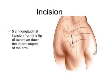 Longitudinal Incision Leg Surgical Approach to Shoulder & Elbow | PPTX