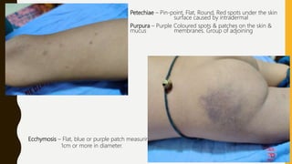 Petechiae – Pin-point, Flat, Round, Red spots under the skin
surface caused by intradermal
Purpura – Purple Coloured spots & patches on the skin &
mucus membranes. Group of adjoining
Ecchymosis – Flat, blue or purple patch measuring
1cm or more in diameter.
 