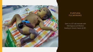 P U R P U R A
F U L M I N A N S
Seen in a D7 old neonate with
Meningococcal Infection
leading to Severe Sepsis & DIC.
 