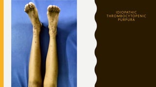 I D I O PAT H I C
T H R O M B O C Y TO P E N I C
P U R P U R A
 