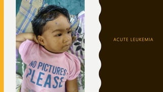 ACUTE LEUKEMIA
 