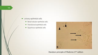  urinary epithelial cells
 Renal tubular epithelial cells
 Transitional epithelial cells
 Squamous epithelial cells
14
Davidson principle of Medicine 21st edition
 