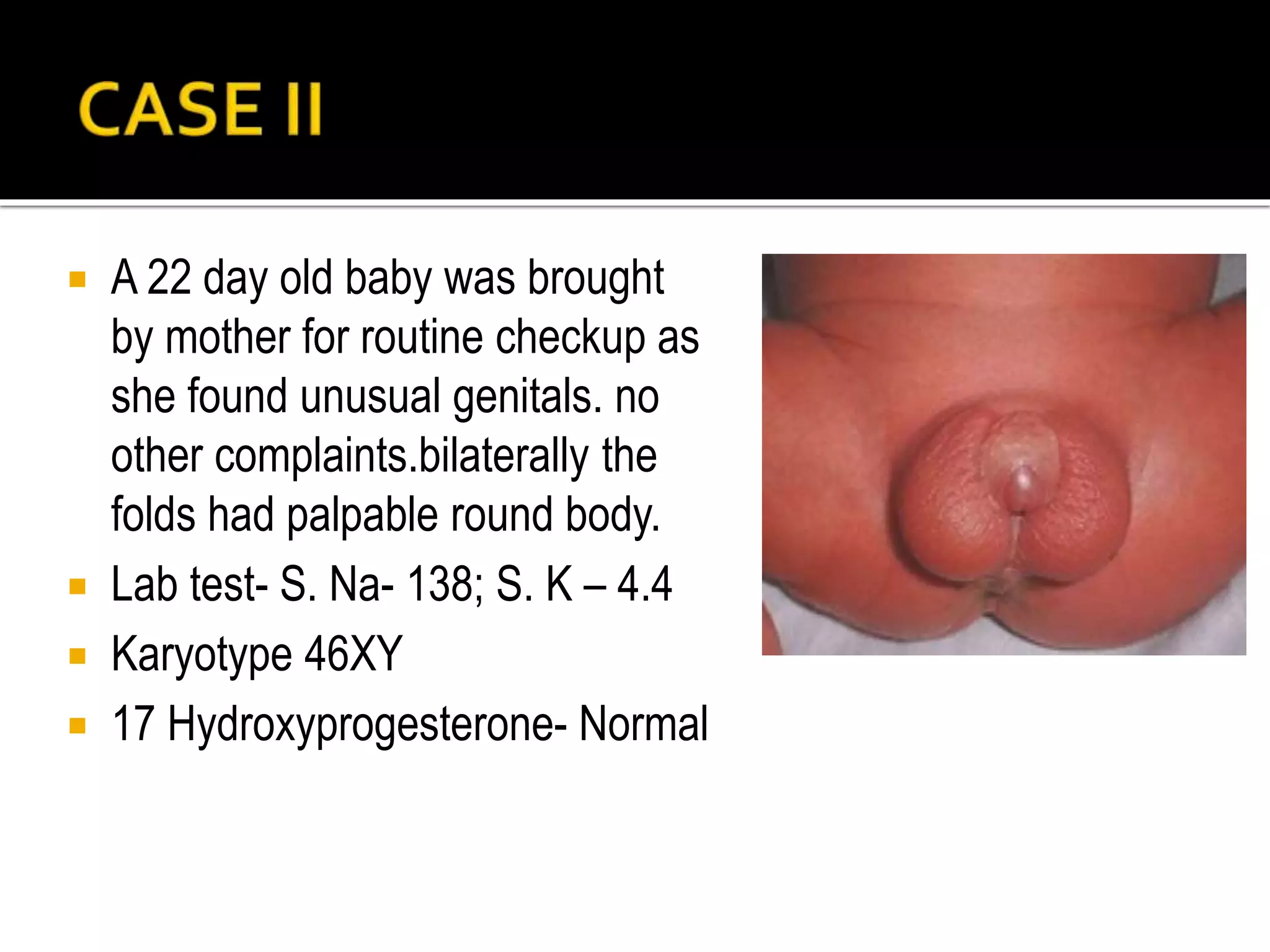  A 22 day old baby was brought 
by mother for routine checkup as 
she found unusual genitals. no 
other complaints.bilaterally the 
folds had palpable round body. 
 Lab test- S. Na- 138; S. K – 4.4 
 Karyotype 46XY 
 17 Hydroxyprogesterone- Normal 
 