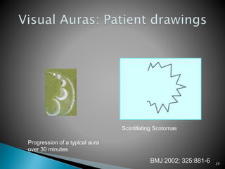 Scintillating Scotomas
Progression of a typical aura
over 30 minutes
BMJ 2002; 325:881-6 29
 