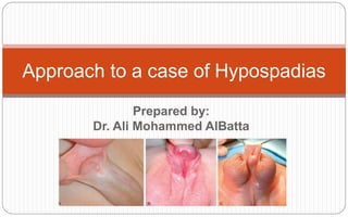 Prepared by:
Dr. Ali Mohammed AlBatta
Approach to a case of Hypospadias
 