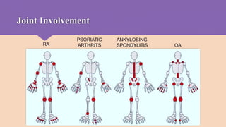 Approach and managment of monoarthritis and polyarthritis | PPTX