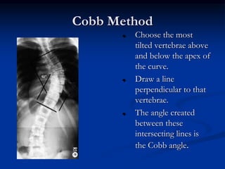 APPROACH_TO_A_CASE_OF_SCOLIOSIS.ppt