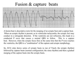 Approach to a case of wide complex tachycardia | PPTX