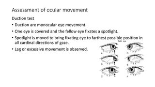 Approach to accommodative esotropia | PPTX