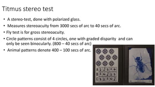 Timus Test Approach to accommodative esotropia | PPTX