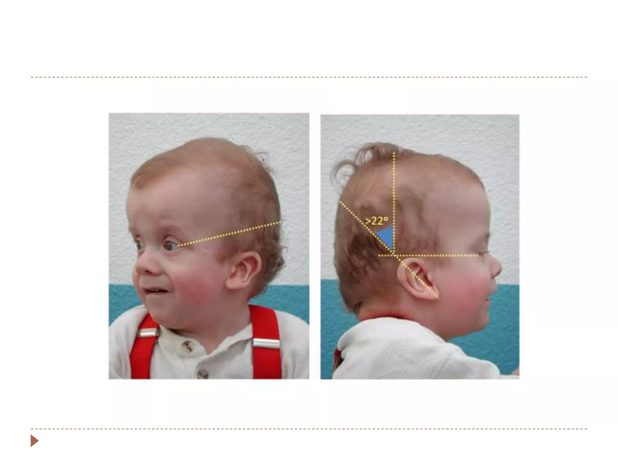 Approach to a child with dysmorphism | PPTX