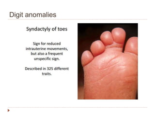 Approach to a child with dysmorphism | PPTX