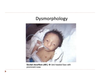Approach to a child with dysmorphism | PPTX