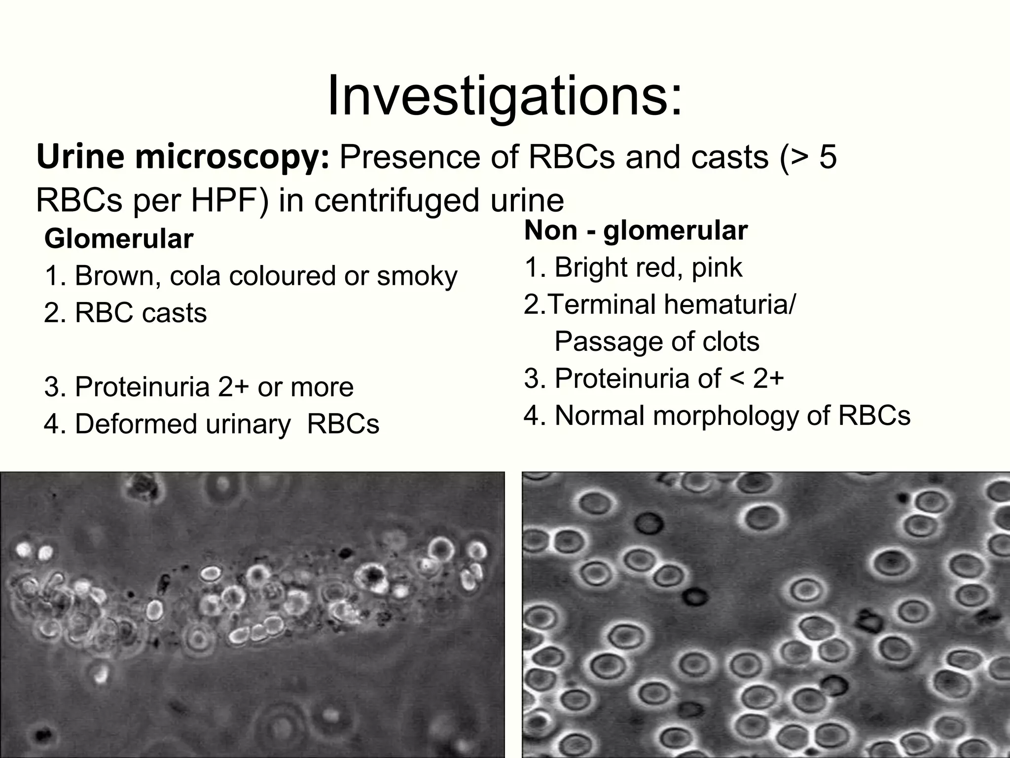 Investigations:
Urine microscopy: Presence of RBCs and casts (> 5
RBCs per HPF) in centrifuged urine
Glomerular                         Non - glomerular
1. Brown, cola coloured or smoky   1. Bright red, pink
2. RBC casts                       2.Terminal hematuria/
                                      Passage of clots
3. Proteinuria 2+ or more          3. Proteinuria of < 2+
4. Deformed urinary RBCs           4. Normal morphology of RBCs
 