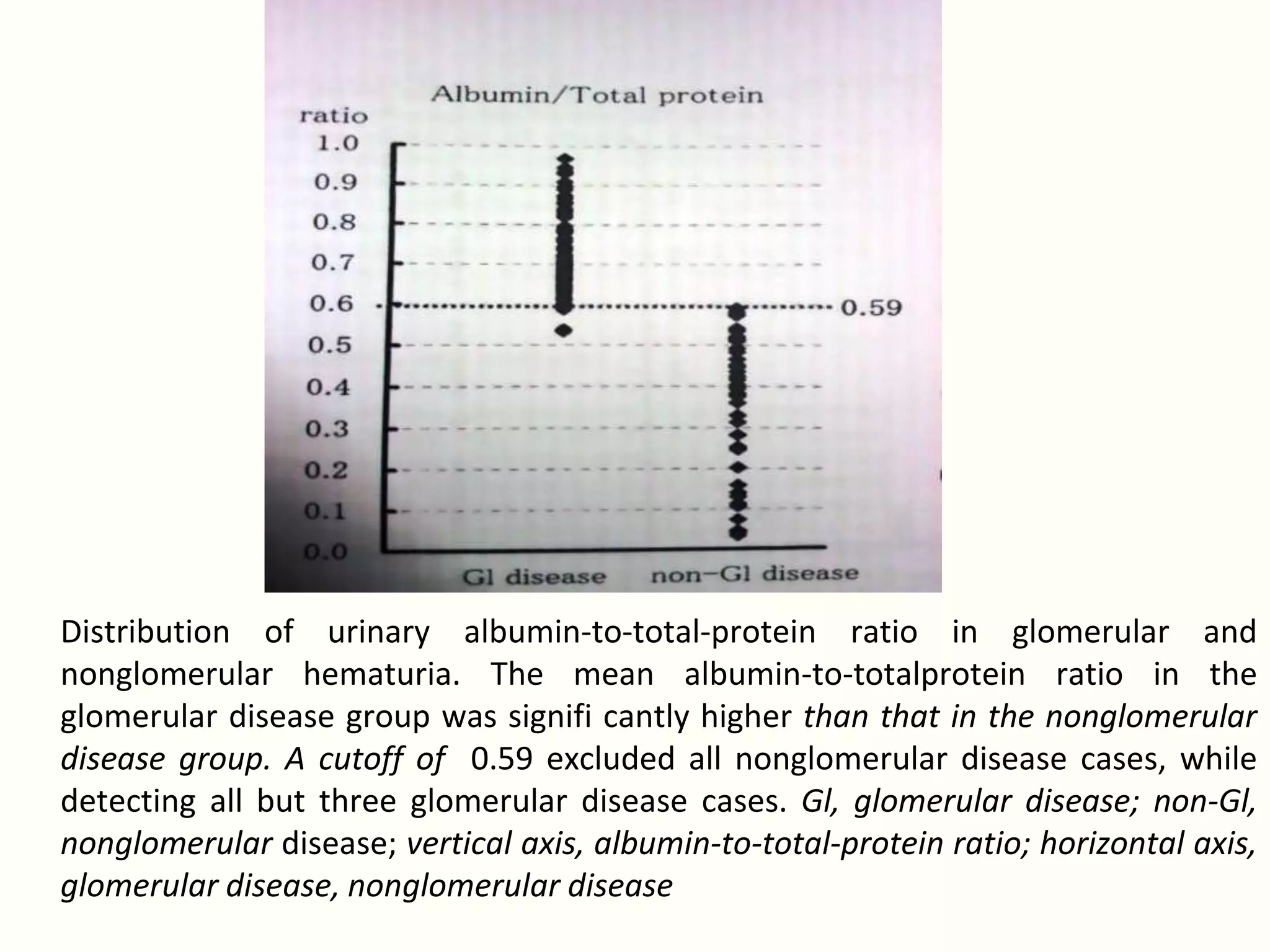 Distribution of urinary albumin-to-total-protein ratio in glomerular and
nonglomerular hematuria. The mean albumin-to-totalprotein ratio in the
glomerular disease group was signifi cantly higher than that in the nonglomerular
disease group. A cutoff of 0.59 excluded all nonglomerular disease cases, while
detecting all but three glomerular disease cases. Gl, glomerular disease; non-Gl,
nonglomerular disease; vertical axis, albumin-to-total-protein ratio; horizontal axis,
glomerular disease, nonglomerular disease
 