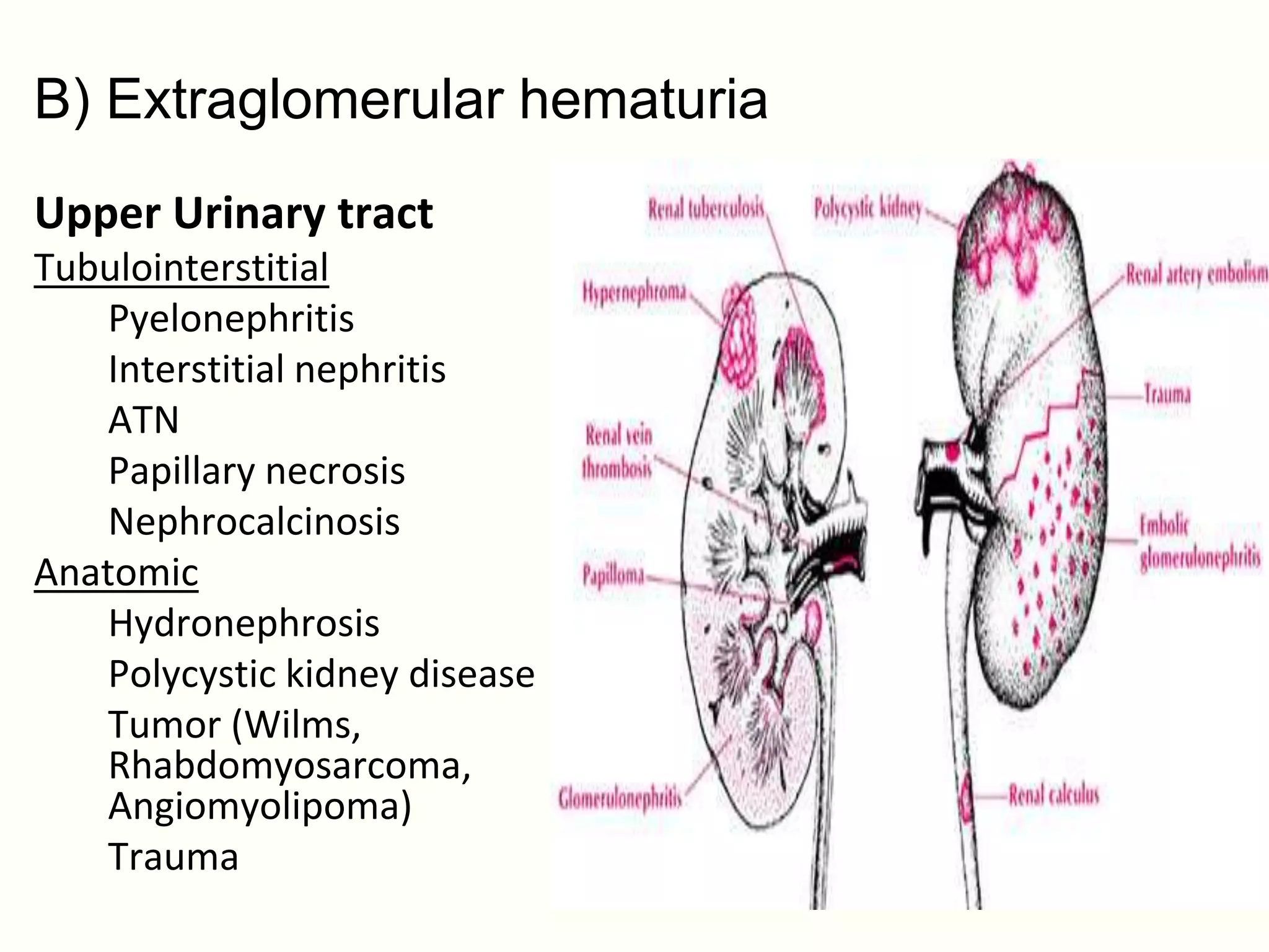 B) Extraglomerular hematuria
Upper Urinary tract
Tubulointerstitial
   Pyelonephritis
   Interstitial nephritis
   ATN
   Papillary necrosis
   Nephrocalcinosis
Anatomic
   Hydronephrosis
   Polycystic kidney disease
   Tumor (Wilms,
   Rhabdomyosarcoma,
   Angiomyolipoma)
   Trauma
 