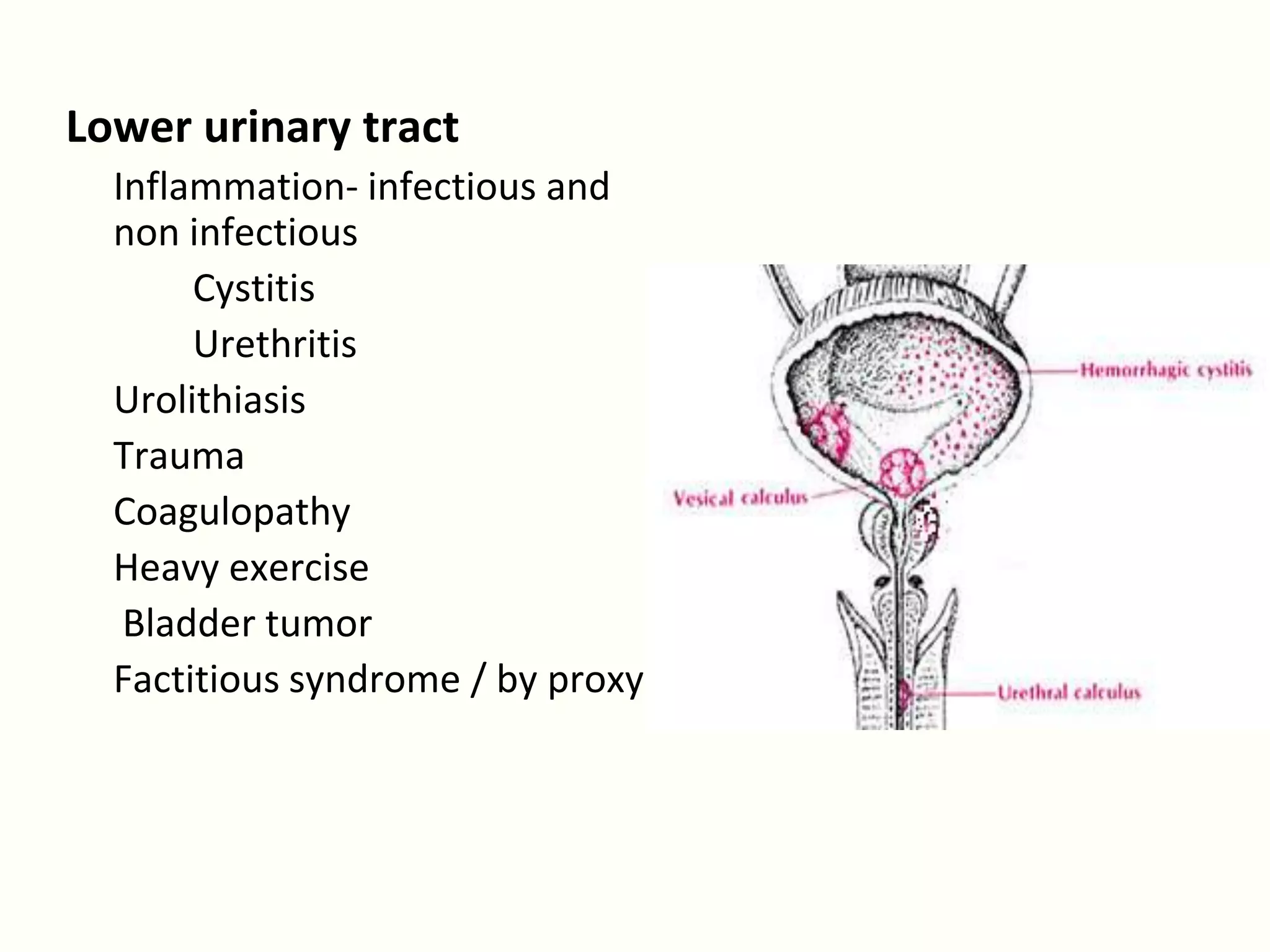 Lower urinary tract
  Inflammation- infectious and
  non infectious
       Cystitis
       Urethritis
  Urolithiasis
  Trauma
  Coagulopathy
  Heavy exercise
   Bladder tumor
  Factitious syndrome / by proxy
 