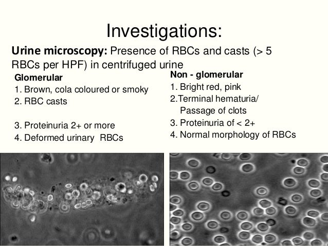 test blood rbc Approach a child with hematuria to test blood rbc Approach a child with hematuria to