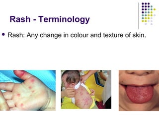 Approach to a_child_with_rash[1] | PPT