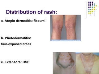 Approach to a_child_with_rash[1] | PPT