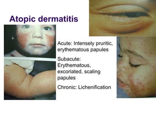 Approach to a_child_with_rash[1] | PPT