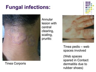 Approach to a_child_with_rash[1] | PPT