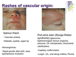 Approach to a_child_with_rash[1] | PPT