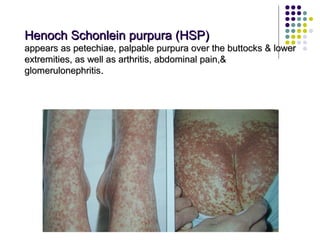 Approach to a_child_with_rash[1] | PPT