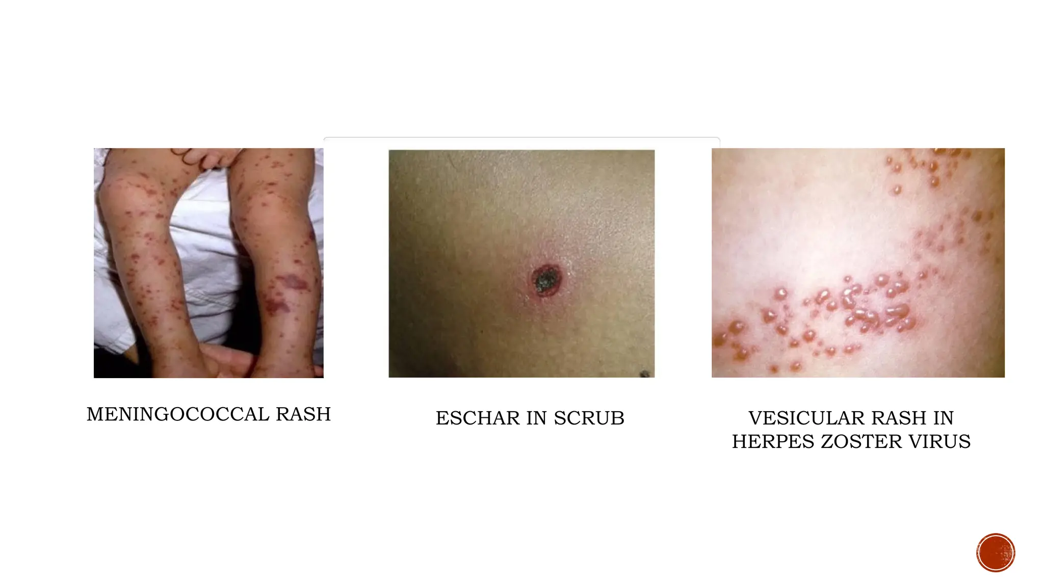 APPROACH TO ACUTE FEBRILE ILLNESS- DIAGNOSIS AND MANAGEMENT | PPTX