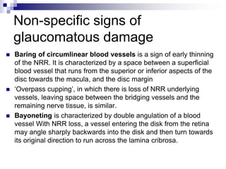 Approach to a glaucoma | PPTX