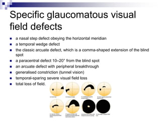 Approach to a glaucoma | PPTX
