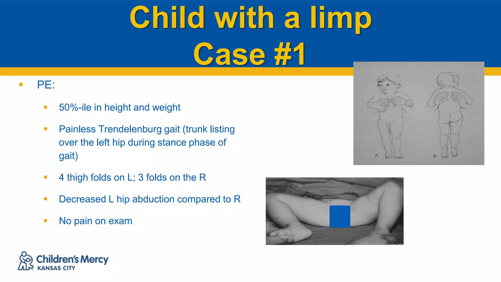 Child with a limp
Case #1
 PE:
 50%-ile in height and weight
 Painless Trendelenburg gait (trunk listing
over the left hip during stance phase of
gait)
 4 thigh folds on L; 3 folds on the R
 Decreased L hip abduction compared to R
 No pain on exam
 