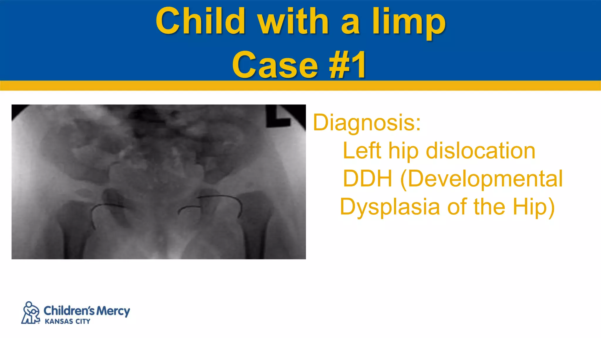 Child with a limp
Case #1
Diagnosis:
Left hip dislocation
DDH (Developmental
Dysplasia of the Hip)
 