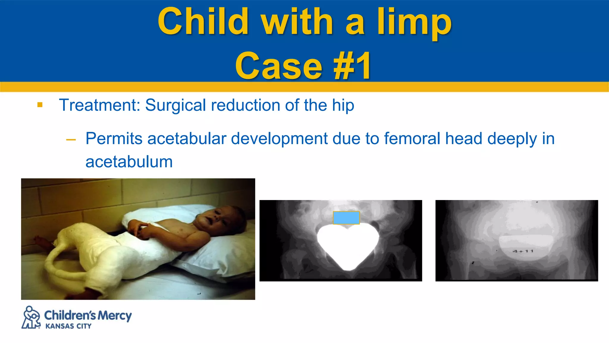 Child with a limp
Case #1
 Treatment: Surgical reduction of the hip
– Permits acetabular development due to femoral head deeply in
acetabulum
 