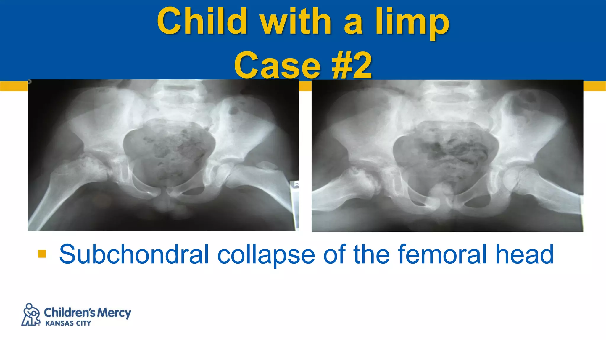 Child with a limp
Case #2
 Subchondral collapse of the femoral head
 
